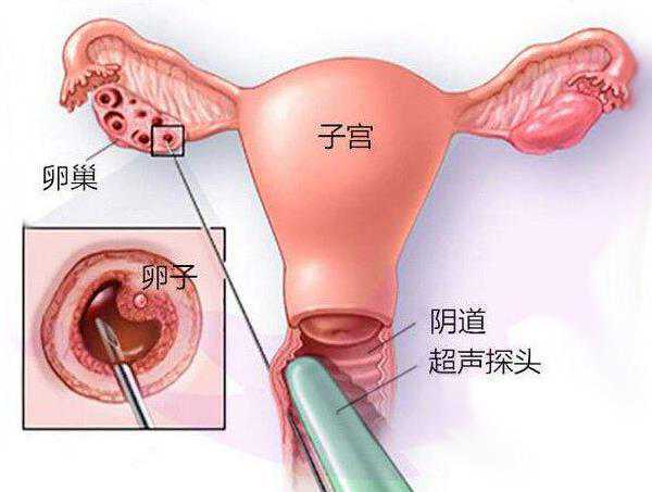 供卵自怀前的子宫评估：检查重点和时间安排